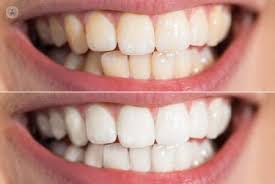 blanqueamiento dental en villa carlos paz